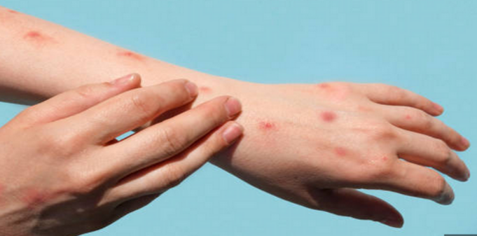 Thumbnail for Mpox surveillance